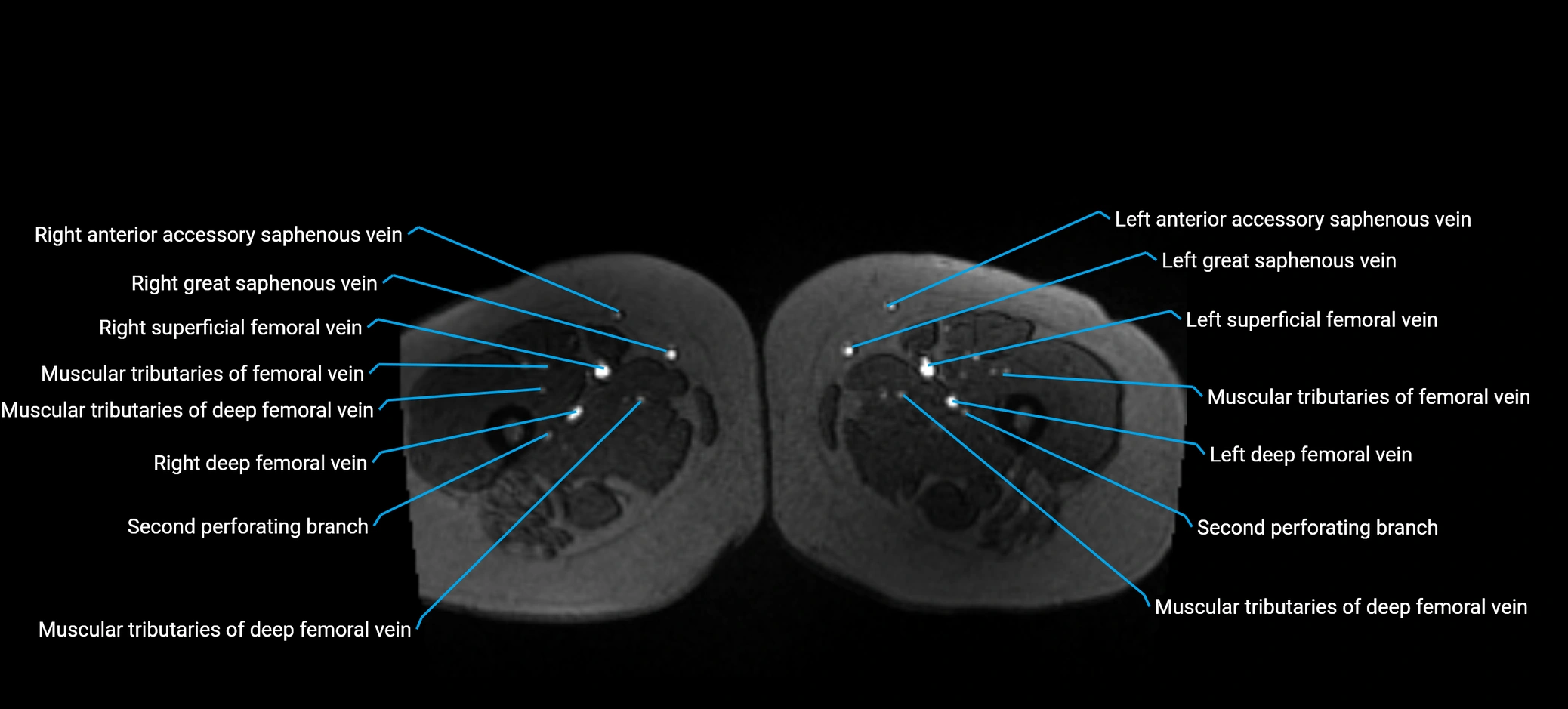 MRV abdomen pelvis & lower limb axial cross sectional anatomy labelled MRI image 234 (1).webp